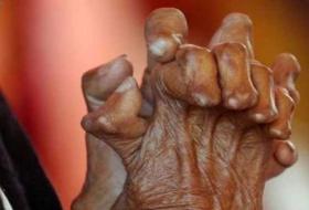 कुष्ठरोग प्रभावितसँग सम्बन्धित नीति तथा कानुन पुनरावलोकन गर्न सुझाव